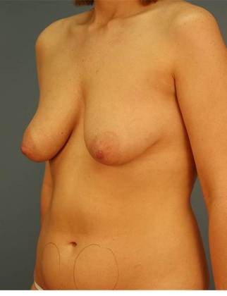 Before Image: Breast Lift: Case 3 - left-front-oblique