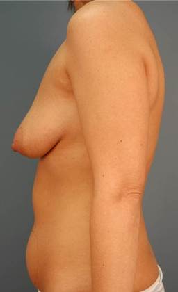 Before Image: Breast Lift: Case 3 - left-side