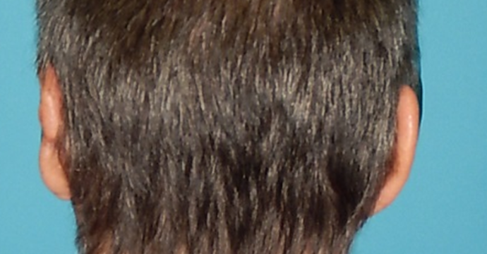 After Image: Otoplasty: Case3 - back