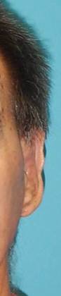After Image: Otoplasty: Case3 - front