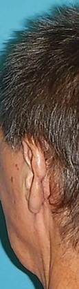 After Image: Otoplasty: Case3 - left-back-oblique