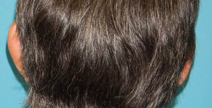 Before Image: Otoplasty: Case3 - back