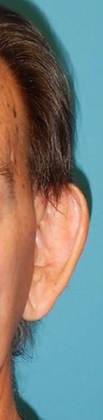 Before Image: Otoplasty: Case3 - front