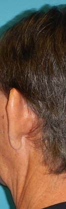 Before Image: Otoplasty: Case3 - left-back-oblique