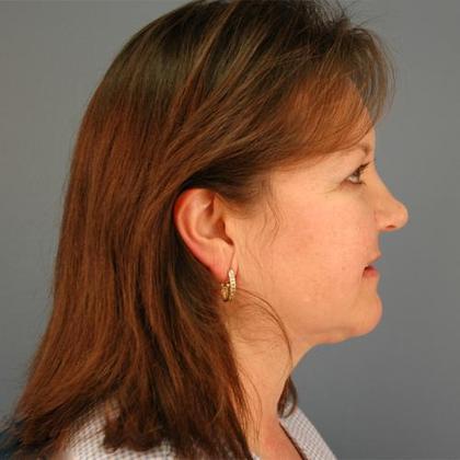 After Image: Eye Lift (Blepharoplasty): Case 3 - right-side