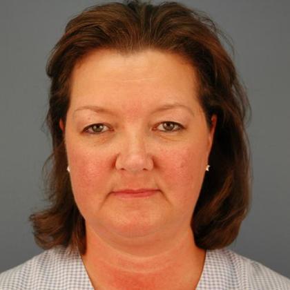 Before Image: Eye Lift (Blepharoplasty): Case 3 - front