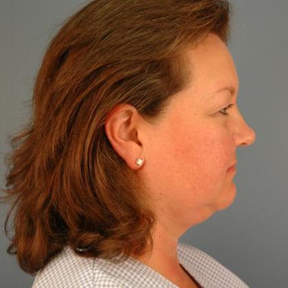 Before Image: Eye Lift (Blepharoplasty): Case 3 - right-side