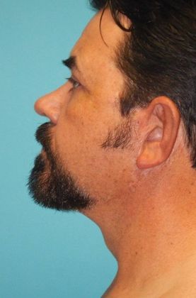 After Image: Neck Lift: Case 3 - left-side