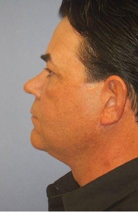 Before Image: Neck Lift: Case 3 - left-side