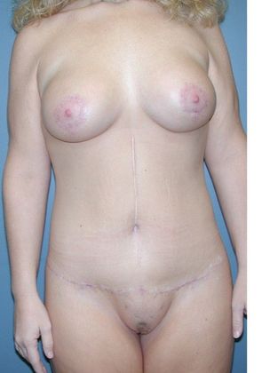 After Image: Body Lifts: Case 3 - front