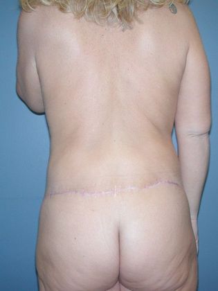After Image: Body Lifts: Case 3 - back