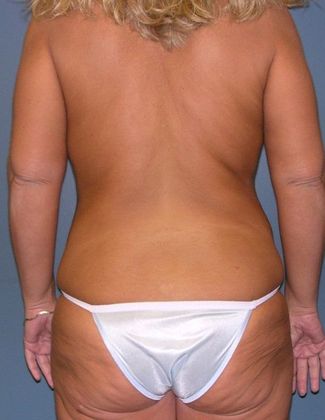 Before Image: Body Lifts: Case 3 - back