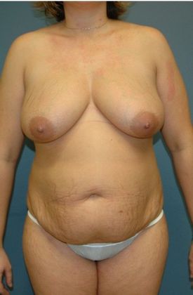 Before Image: Mommy Makeover: Case 3 - front