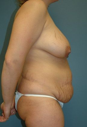 Before Image: Mommy Makeover: Case 3 - right-side