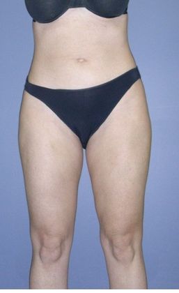 After Image: Liposuction: Case 3 - front