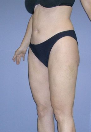 After Image: Liposuction: Case 3 - left-front-oblique
