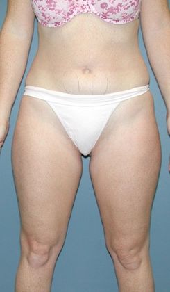 Before Image: Liposuction: Case 3 - front