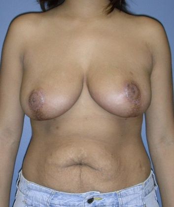 After Image: Breast Reduction: Case 3 - front