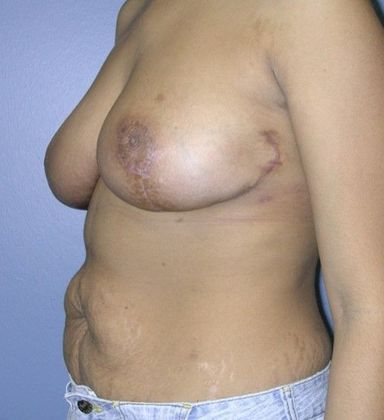 After Image: Breast Reduction: Case 3 - left-front-oblique