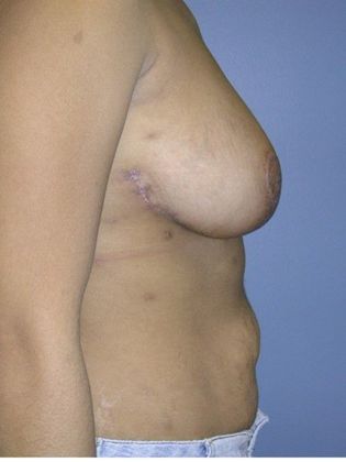 After Image: Breast Reduction: Case 3 - right-side