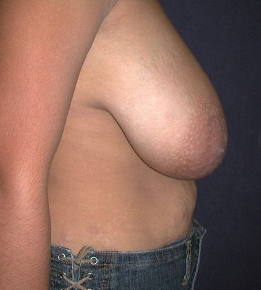 Before Image: Breast Reduction: Case 3 - right-side