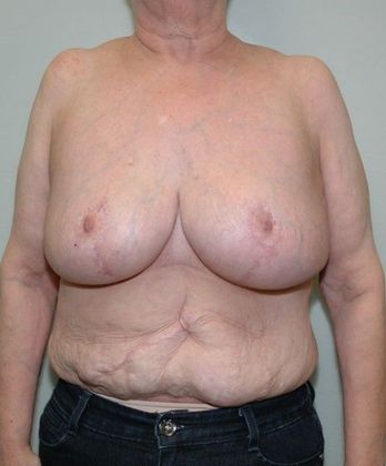 After Image: Arm Lift: Case 3 - front