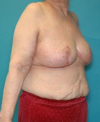 After Image: Arm Lift: Case 3 - right-front-oblique