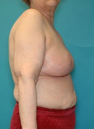After Image: Arm Lift: Case 3 - right-side