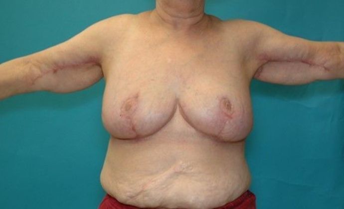After Image: Arm Lift: Case 3 - front