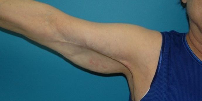 After Image: Arm Lift: Case 3 - front