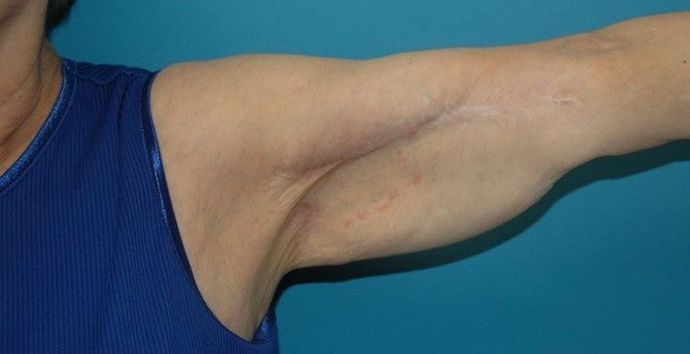 After Image: Arm Lift: Case 3 - front