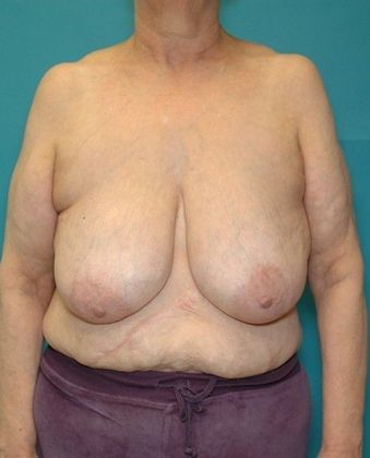 Before Image: Arm Lift: Case 3 - front
