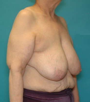 Before Image: Arm Lift: Case 3 - right-front-oblique