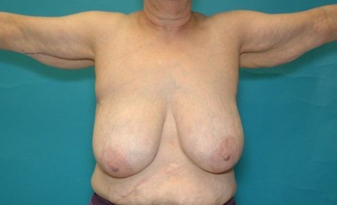 Before Image: Arm Lift: Case 3 - front