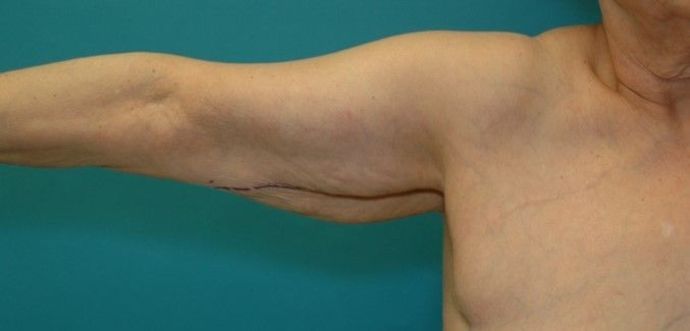 Before Image: Arm Lift: Case 3 - front