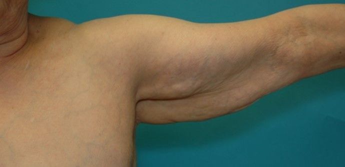 Before Image: Arm Lift: Case 3 - front