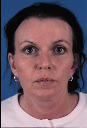 After Image: Brow Lift: Case 3 - front