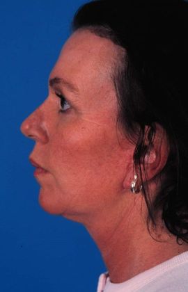 After Image: Brow Lift: Case 3 - left-side