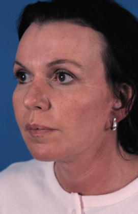 After Image: Brow Lift: Case 3 - left-front-oblique