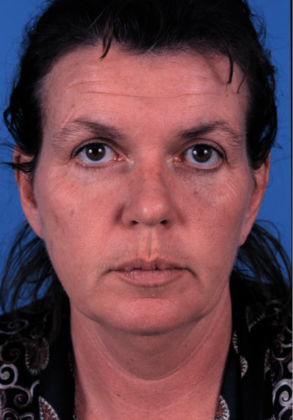 Before Image: Brow Lift: Case 3 - front