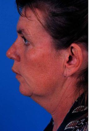 Before Image: Brow Lift: Case 3 - left-side