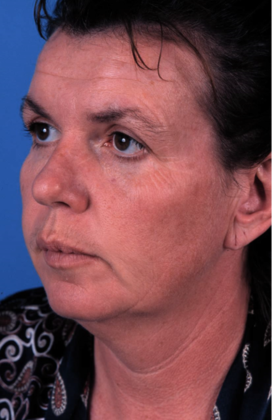 Before Image: Brow Lift: Case 3 - left-front-oblique