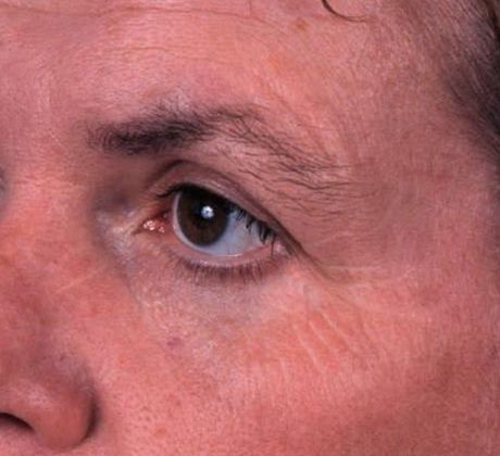 Before Image: Brow Lift: Case 3 - left-front-oblique