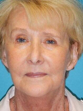 After Image: Face & Neck Lifts: Case 3 - front