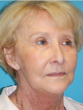 After Image: Face & Neck Lifts: Case 3 - right-front-oblique