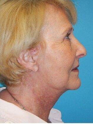 After Image: Face & Neck Lifts: Case 3 - right-side