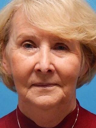 Before Image: Face & Neck Lifts: Case 3 - front
