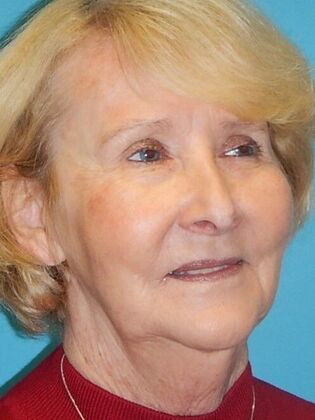 Before Image: Face & Neck Lifts: Case 3 - right-front-oblique