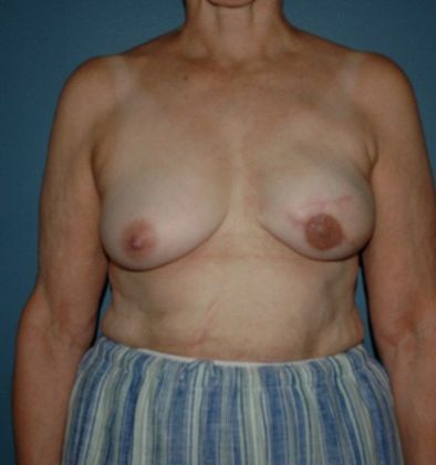 After Image: Breast Reconstruction: Case 3 - front