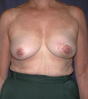 Before Image: Breast Reconstruction: Case 3 - front